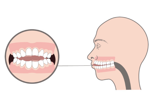 Orofacial Myofunctional Disorders-OMDs