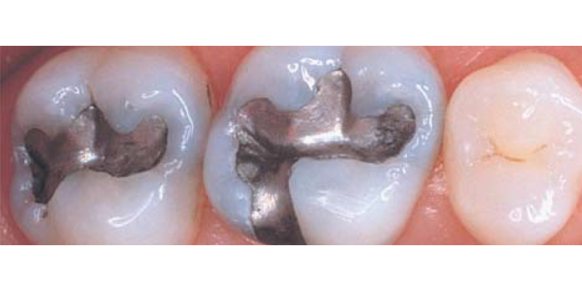 Amalgam Removal Changed My Life