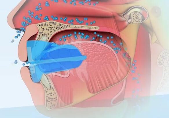 mouth breathing dental problems